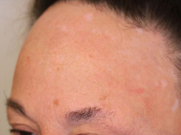 kas_kirpik_dokulmesi_frontal_fibrozan_alopesi.jpg