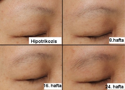 kas_seyrekligi_dokulme_hipotrikozis_madarozis_2.jpg