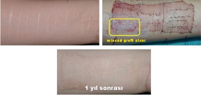 kesi_jilet_falcata_izleri_90_derece_rotasyon__deri_greftleri_3.jpg