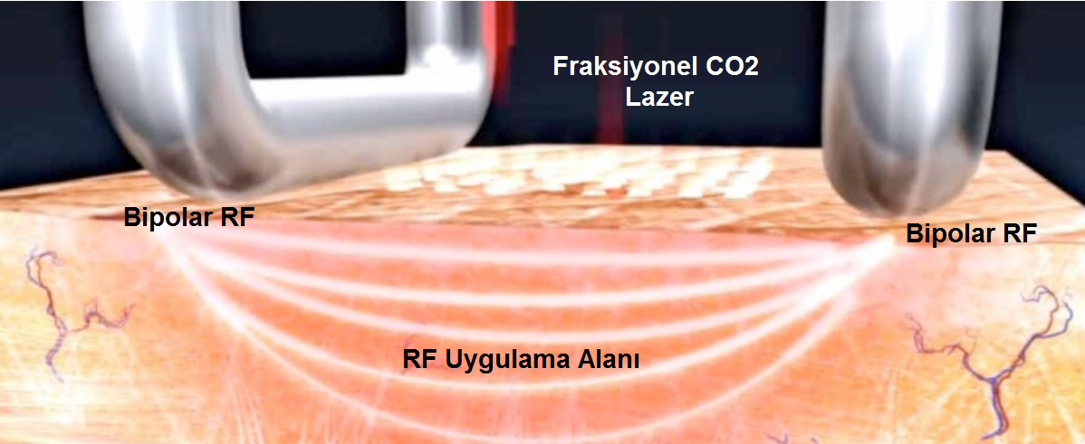 Merkezimizde Kullanılan Fraksiyonel CO2 Lazer