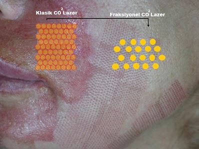 Cilt Yenileme ve Gençleştirmede Klasik yada Fraksiyonel Karbondioksit Lazerler