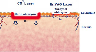 Cilt Gençleştirmede Ablatif Lazer Uygulamaları