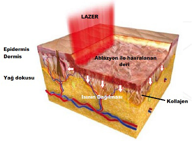 Cilt Gençleştirmede Ablatif Lazer Uygulamaları