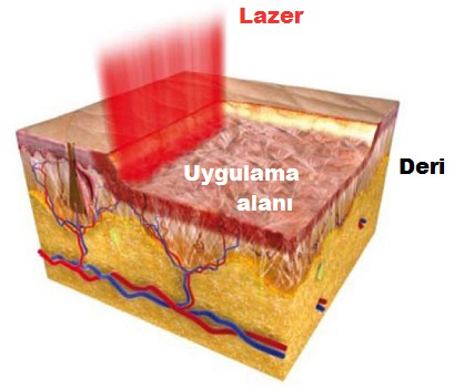 Ablatif Lazerin Uygulanması ve Sonrası