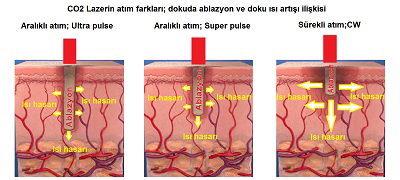 Fraksiyonel CO2 Lazer Mi, Klasik CO2 Lazer Mi?