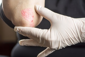 Psoriasis, Sedef PDL Kullanımı 