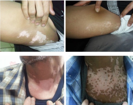 Vitiligo Tedavisi; Fraksiyonel Karbondioksit Lazer, 308 nm Excilite, PRP Kombinasyonu