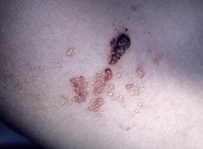 lenfanjioma_01.jpg