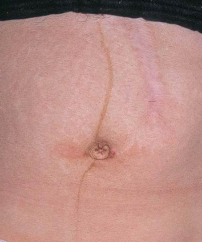 linea_nigra.jpg