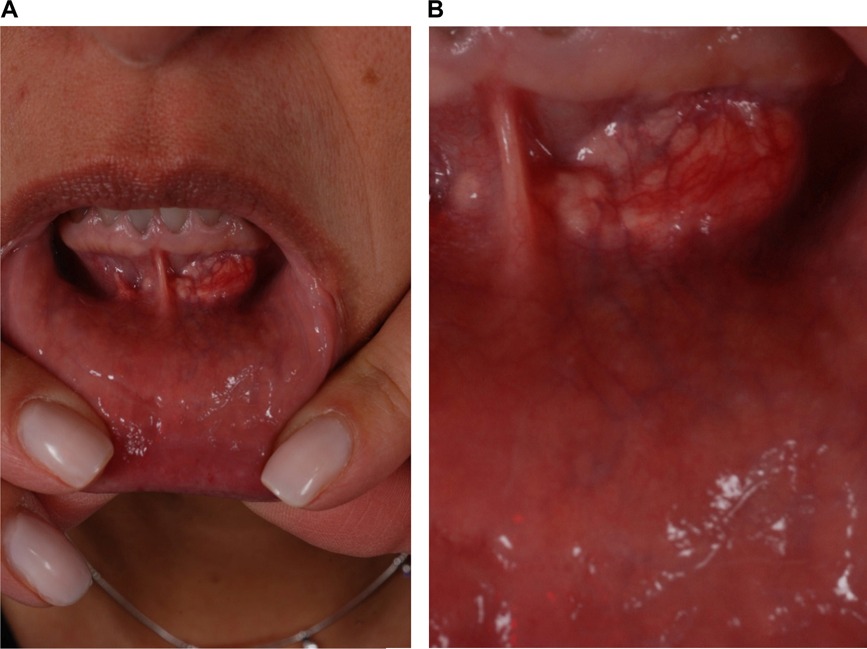 inflamatuara olmayan noduller