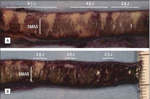 Yüz ve Boyun Gençleştirmede SMAS Ultherapy