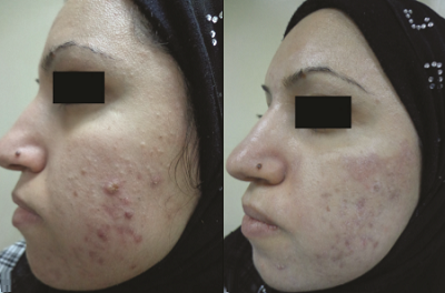 Akne Tedavisinde Kimyasal Peeling