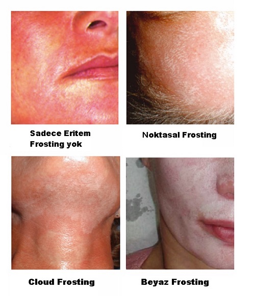 Cilt Gençleştirmede TCAA Kimyasal Peeling