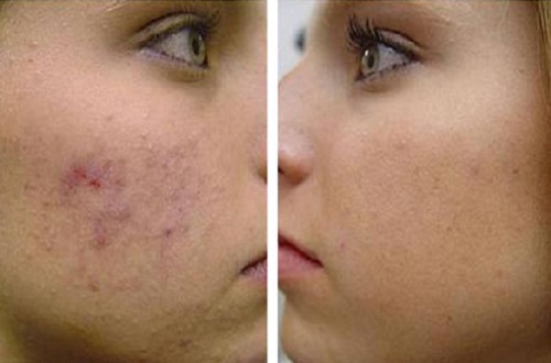 Akne Tedavisinde Kimyasal Peeling