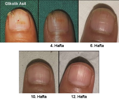 Tırnaklarda Kimyasal Peeling