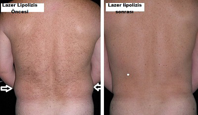 Bel Kısmında Lazer Lipolizis