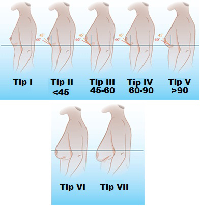 Jinekomasti'nin Klinik Sınıflaması