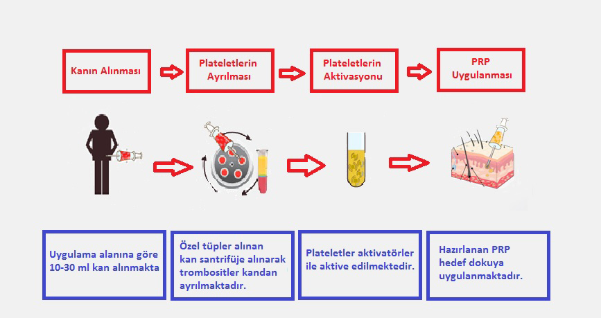 PRP Uygulaması Nasıl Yapılır?