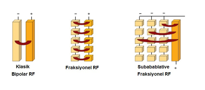 Fraksiyonel RF