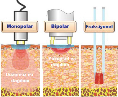 rf uygulama sekilleri 02