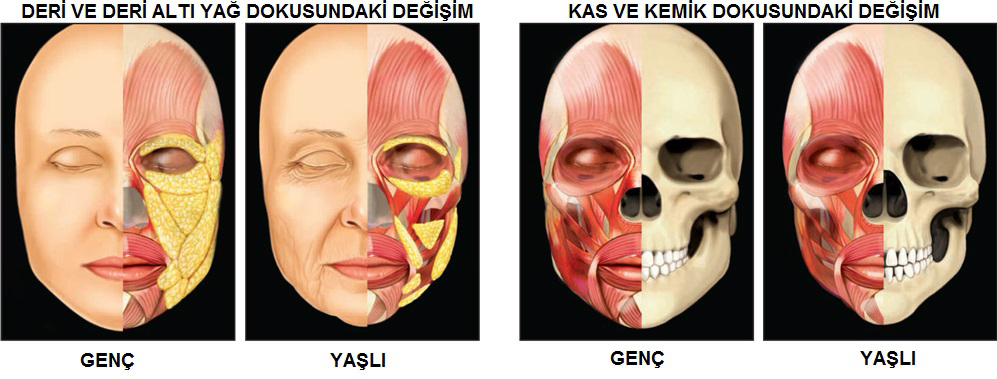 Göz Çevresine Yağ Enjeksiyonu ve PRP