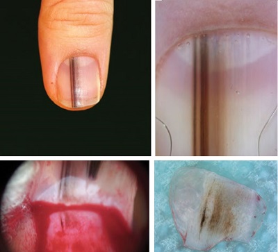 melanoma-dermoskopi.jpg