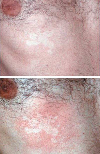nevus_anemikus_01.jpg