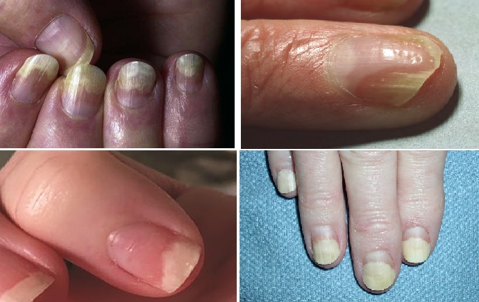 onikolizis_onycholysis_1.jpg
