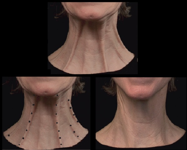 platysma_kasi_botox_2.jpg