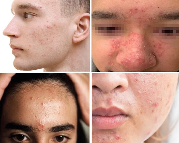 Prepubertal Acne, Preadelösan Akne, Ergenlik Öncesi Akne