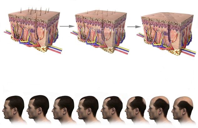 Androgenetik Alopesi'de Klinik Sınıflama