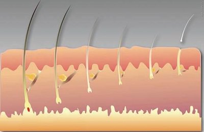 Androgenetik Alopesi'de Klinik Sınıflama