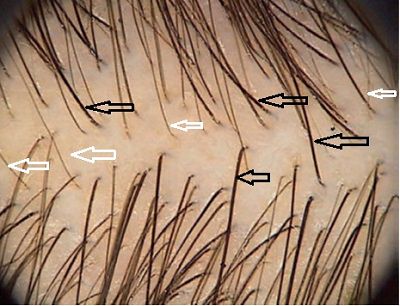 Androgenetik Alopesi'de Klinik Sınıflama