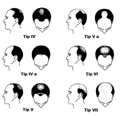 Androgenetik Alopesi'de Klinik Sınıflama