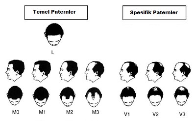 Androgenetik Alopesi'de Klinik Sınıflama