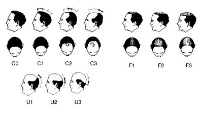 Androgenetik Alopesi'de Klinik Sınıflama