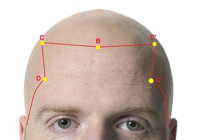 Saç ekiminde ön saç çizgisinin belirlenmesi