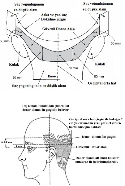 Saç Ekiminde Donör Alanın Değerlendirilmesi