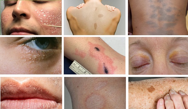 Dermatolojide Spot Olarak Tanımlanan Özel Lekeler