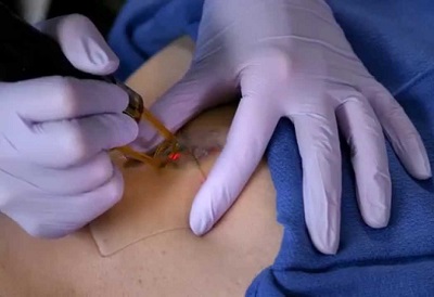 tatoo_dovme_silme_lazer_PFD_silikon.jpg