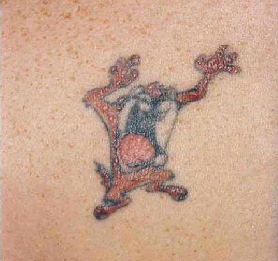 Dövme(Tattoo) Alerjisi ve Alerjik Olmayan Reaksiyonlar