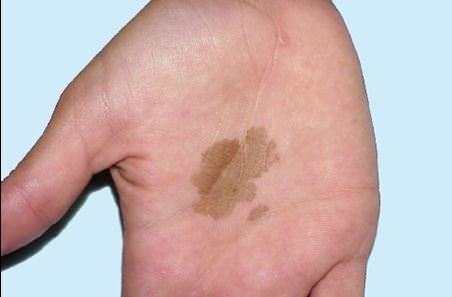 tinea-nigra-01.jpg