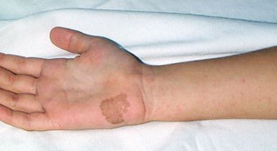 tinea-nigra-02.jpg