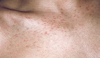 tinea-versicolor-05.jpg