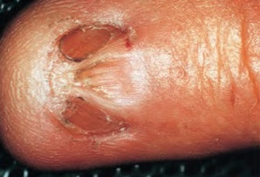 tirnak-dorsal-piterjium.jpg