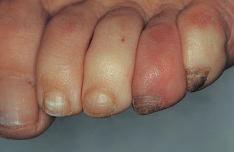 tirnak-raynaud-fenomeni.jpg