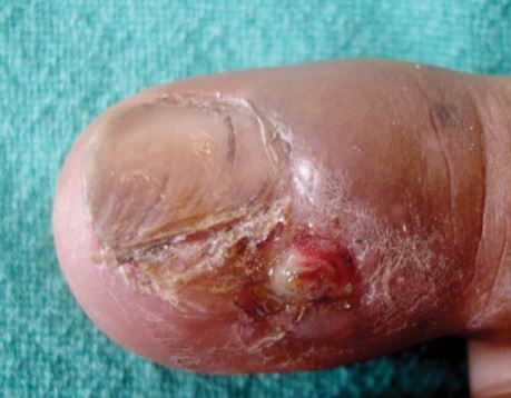 tirnak-tuberkulosis.jpg