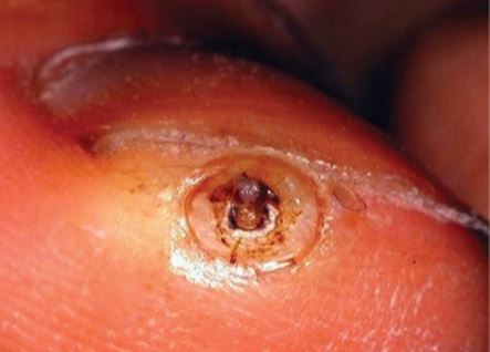 tirnak-tungiasis.jpg
