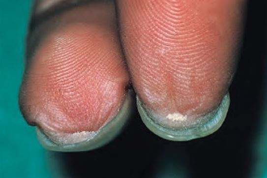 tirnak-ventral-piterjium.jpg