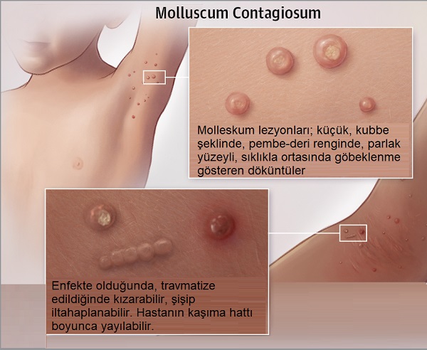 Molluskum Kontagiozum, Molluscum contagiosum